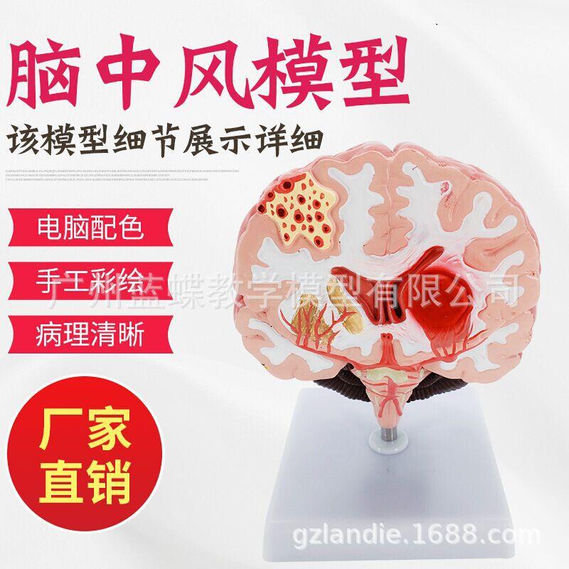 人体大脑解剖 脑/中风模型 脑部疾病模型 脑淤血 脑病变解剖模型