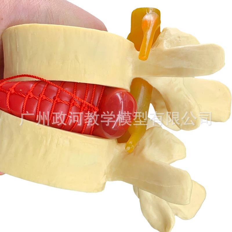医用人体腰椎间盘病变演示模型 腰椎模型 脊柱模型 脊椎模型 骨科