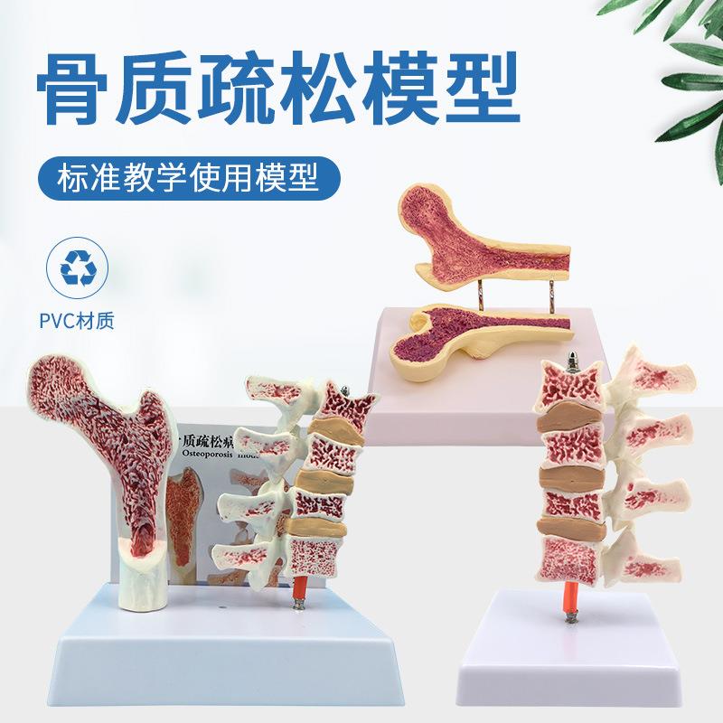 人体股骨 骨质疏松 病变腰椎解剖模型 腿骨解剖面 脊柱切面 标本