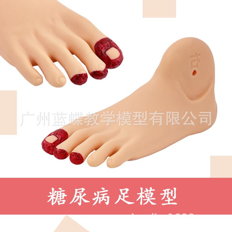 糖尿 病足护理模型 足部糖 尿病 病理变化 足部脚部病变 PVC材质