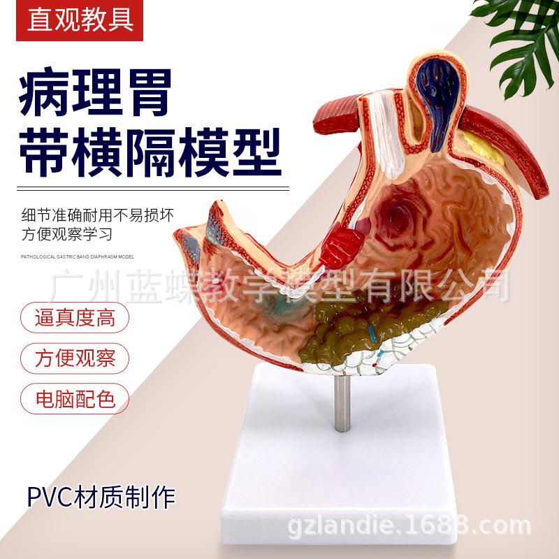 胃解剖模型 病变胃模型 胃部疾病演示模型 病理胃模型 人体胃模型