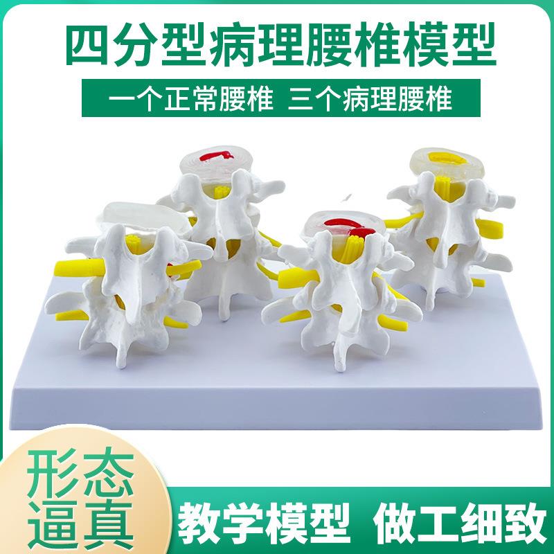 四分型脊椎正常与病变腰椎组合模型 椎间盘病理腰椎演示过程 病变