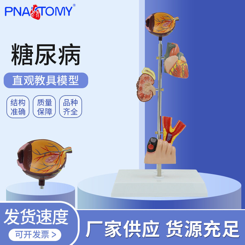 糖尿 病病理模型眼球 心肾脏 动脉 硬化糖尿 病足 糖尿 病并发症