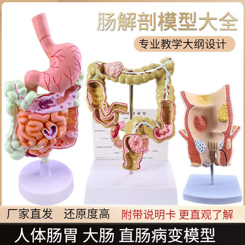 大肠病理模型肠胃病变解剖模型直肠模型肠道疾病人体结肠病理模型