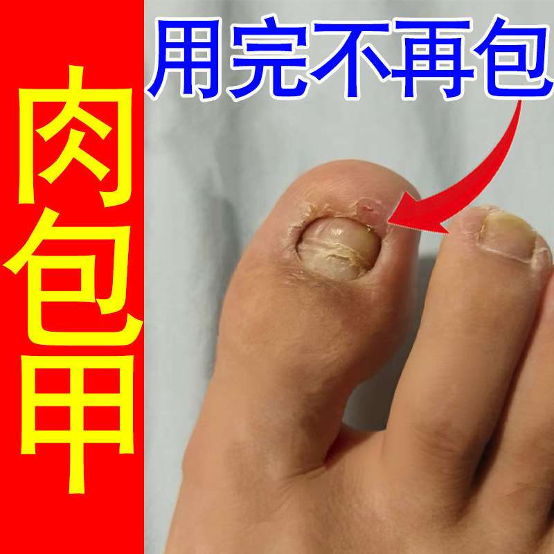 Children with Short, Brittle Nails That Are Prone to Biting, Causing Nail Damage, Recession, Unevenness, Breakage, Vertical Lines, and Thickening, Need Repair and Growth Children with Short, Brittle Nails That Are Prone to Biting, Causing Nail Damage, Recession, Unevenness, Breakage, Vertical Lines, and Thickening, Need Repair and Growth