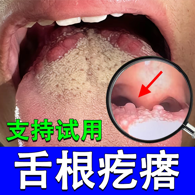 A Lump on the Back of the Tongue, Swelling, Dryness, Itching, Sensation of Foreign Body, Pain, Pustules, Bumps on Both Sides of the Tongue, Pure Herbal Spray for Repair A Lump on the Back of the Tongue, Swelling, Dryness, Itching, Sensation of Foreign Body, Pain, Pustules, Bumps on Both Sides of the Tongue, Pure Herbal Spray for Repair