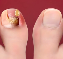 No guarantee no repair. Just put one drop in the morning and evening. The effect is great. Bad nails turn into good ones. Finger and toes are repaired and turned into good ones.