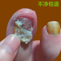 Tongrentang hot sale 100000 non-guaranteed no repair (one drop) painlessly removes bad potassium from hands and toes gray potassium nemesis
