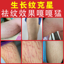 Obesity Line Repair Cream Growth Line Elimination Thigh Student Removal Mens Fading Lines Obesity Line Repair Cream
