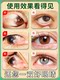 Eye Drops to Remove Styes, Blurry Vision, and Foreign Body Sensation; Medicine for Treating Wing-Shaped Styes in the Corners of the Eyes