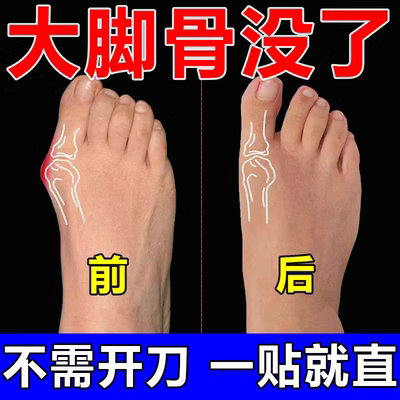 Thumb valgus (early use early Good) Thumb Valgus Muscle Sticking Big Toe Overlap Joint Swollen Special Effects Sticker-Taobao