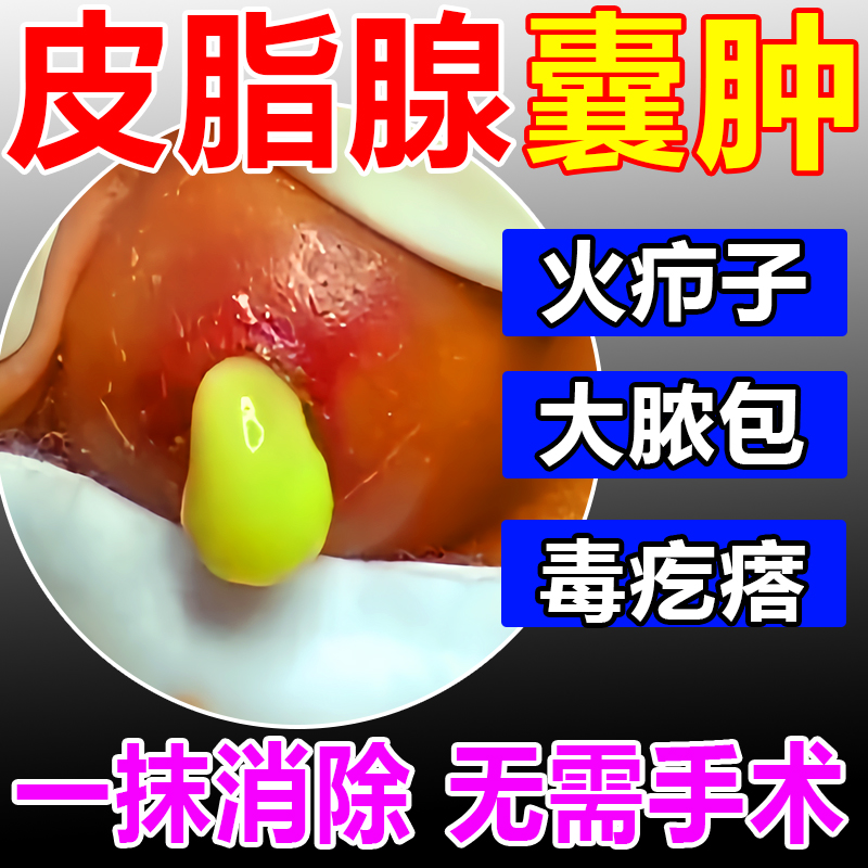 Sebaceous glandular cream removal of subcutaneous pink tumor abscess Acne Fire furuncle Tubal Ligator with Courtesy Cream-Taobao