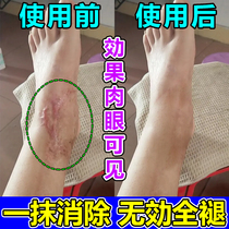 Scar lingo chest front hyperplasia concave bumps soften the repair cream to remove the scar-sticking ear-hole scar Cream