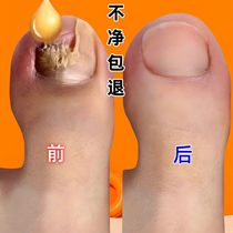 (Tongrentang hot sale) Painless replacement of potassium enjoy a good nail life turn bad nails into good ones drop by drop