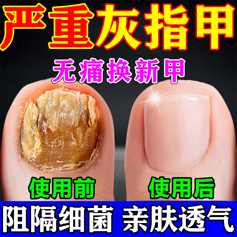 Special Nail Fungus Patch for Onychomycosis, Painless Nail Removal, Thickened Onychomycosis, Bad Nails, Hollow Nails, Paronychia Correction Patch