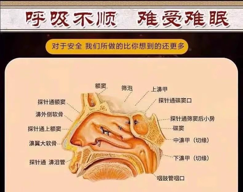 草廷神醫鼻炎膏,鼻炎专用特效药过敏性鼻炎去根特效断根非喷雾鼻窦炎流鼻涕通气膏 草廷神醫鼻炎膏