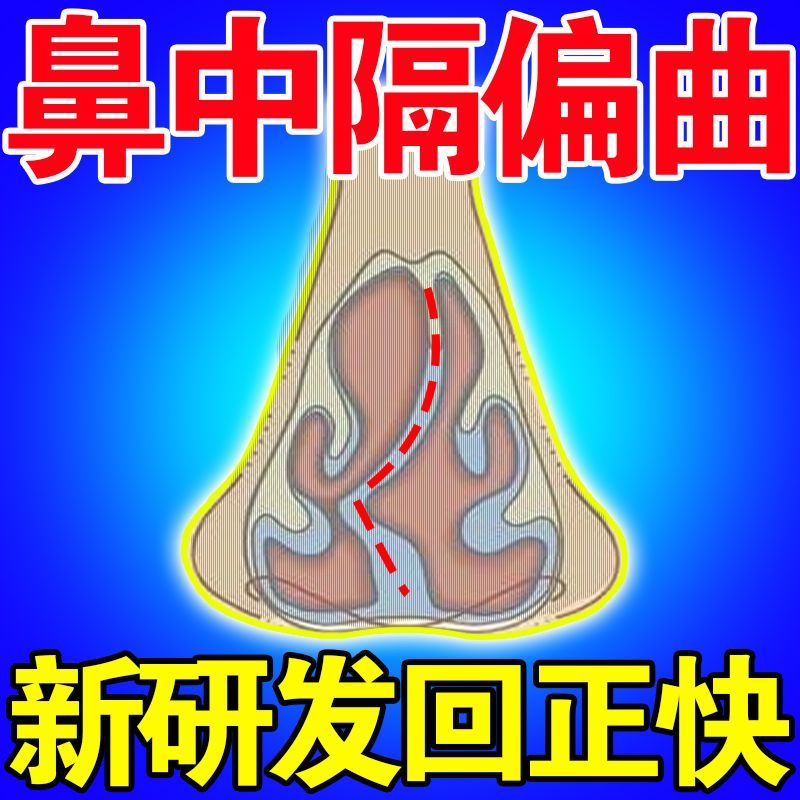 鼻中隔偏位矯正装置アーチファクト鼻甲介肥大鼻づまり特殊換気鼻孔サポート鼻柱の拡張と拡張