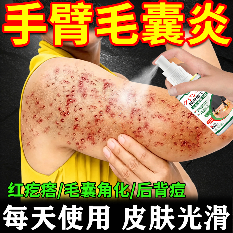 Folliculitis on the Arm, Specialized Spray for Pimples and Hard Bumps on the Back, Malassezia Infection Spray