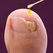 (Watson’s hot sale) One drop of it inhibits bacteria without removing nails removes 99% of gray potassium fungi unisex
