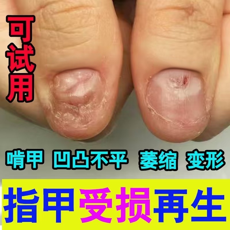 Nail Repair, Damaged Nail Regeneration, Nail Bed Care, Nail Shrinkage, Deformation, Unevenness, Nail Biting, Nail Growth Promotion Nail Repair, Damaged Nail Regeneration, Nail Bed Care, Nail Shrinkage, Deformation, Unevenness, Nail Biting, Nail Growth Promotion