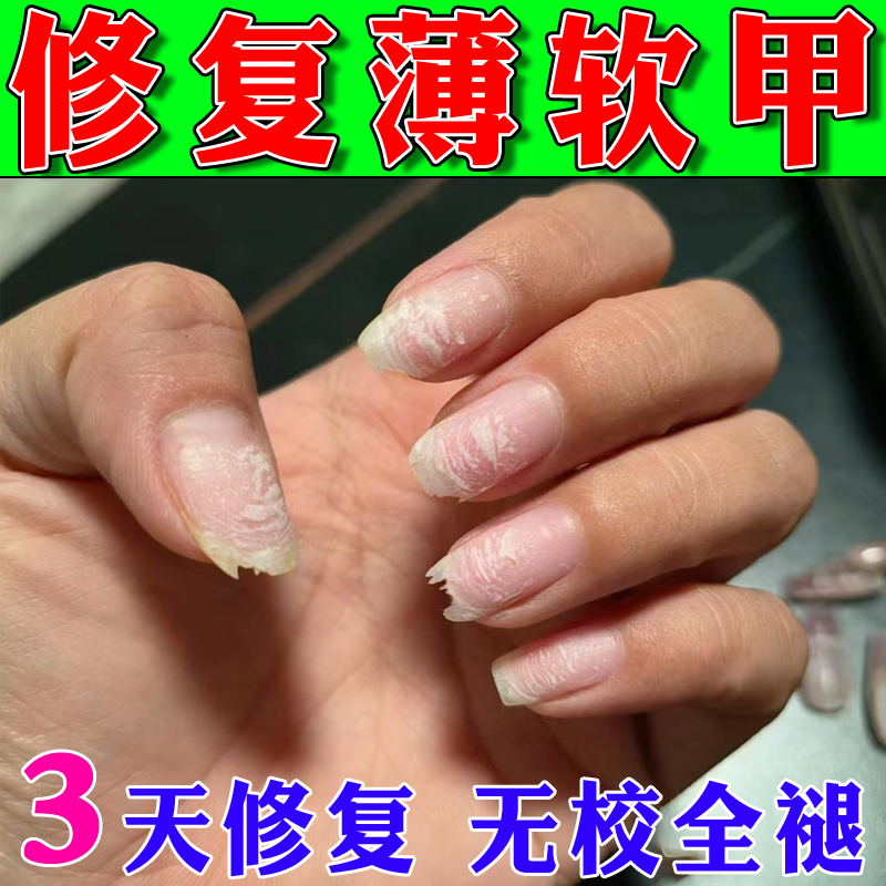 Thin, Soft, and Easily Broken Nails Repair and Regenerate Damaged Nails after Manicure, Cracked Nails, Uneven Interface, Thickening Growth Liquid