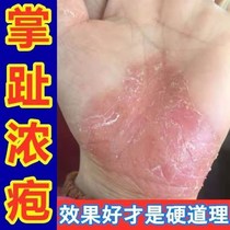 Rapid delivery Palmoplantar keratosis Palmoplantar pustulosis Keratosis Palmoplantar pustulosis Hands and feet Sloughing and cracked horny skin