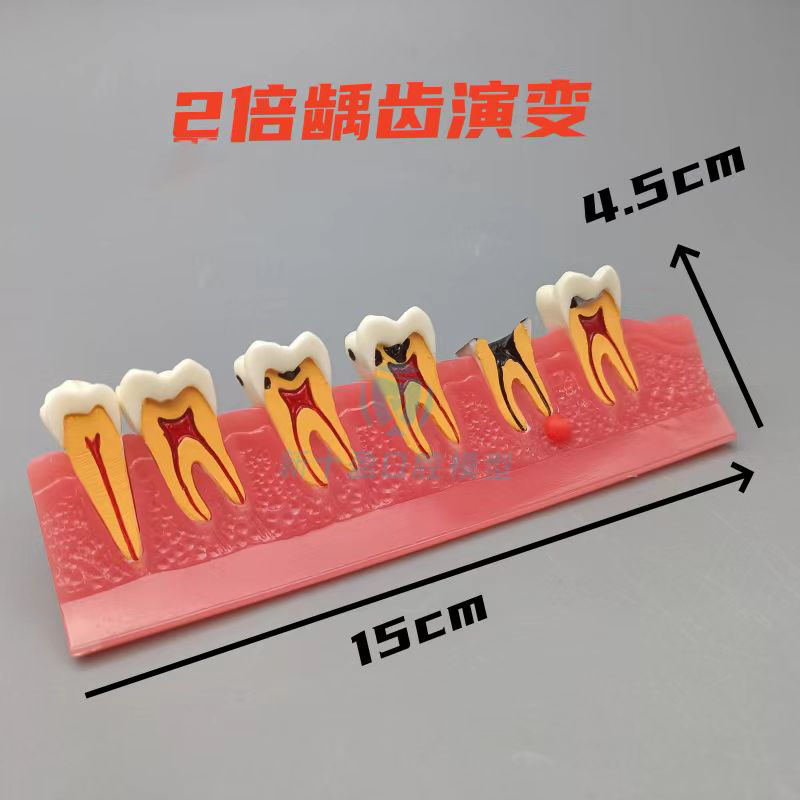 牙齿牙科口腔牙模牙周分类模型龋齿变重蛀牙过程病理医患沟通展示