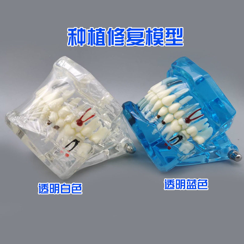 牙科成人修复可拆卸连桥修复 综合活动牙种植牙模可拆卸教学模型