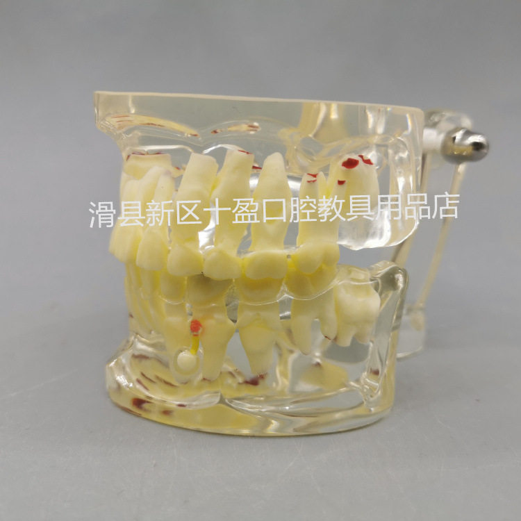 牙科 儿童病理模型 牙齿龋坏 乳牙恒牙交替更换牙粒模型病理模型