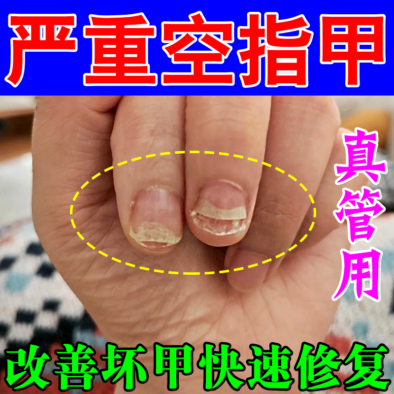 Nail Hollowing Repair Solution, a Medicine Specifically for Treating Fungal Infections of Fingernails, Layered Uneven Hollow Nails
