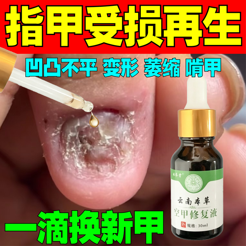 Nail Crack Repair, Vertical Lines on Nails, Damaged Nail Flesh, Separation of Nail Surface, Layered Nails, Uneven Nail Surface, Herbal Liquid Nail Crack Repair, Vertical Lines on Nails, Damaged Nail Flesh, Separation of Nail Surface, Layered Nails, Uneven Nail Surface, Herbal Liquid
