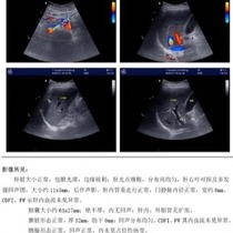 Hospital film inkjet laser porcelain white translucent color gastroscope B-ultrasound four-dimensional color ultrasound printing film paper