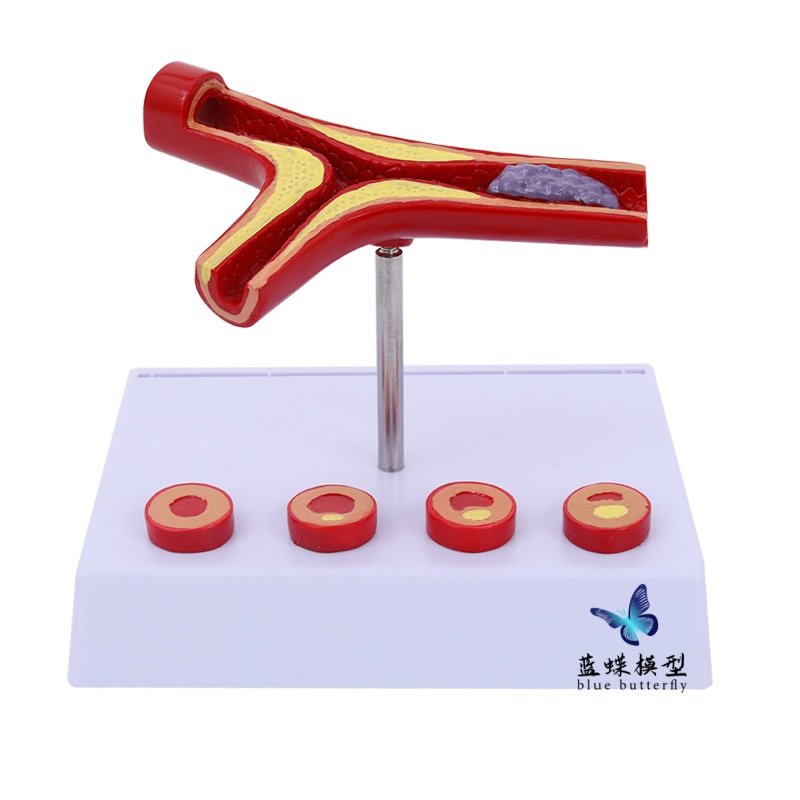 Human Cardiovascular Hierarchical Structure Anatomy Blockage Model Thrombosis Fat Pathology Arteriovenous Enlargement and Hardening Teaching Aids