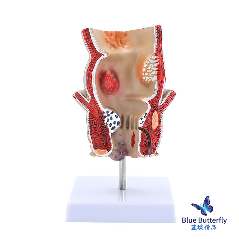 Straight Intestines Hemorrhoids Disease Turns into Model Hemorrhoids Internal and External Anatomy Anal and Intestinal Surgery Large Intestine Intestinal Pathology Model