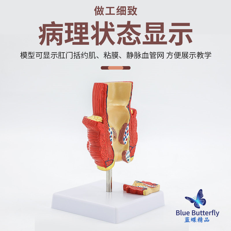 Straight Intestines Hemorrhoids Disease Turns into Model Hemorrhoids Internal and External Anatomy Anal and Intestinal Surgery Large Intestine Intestinal Pathology Model