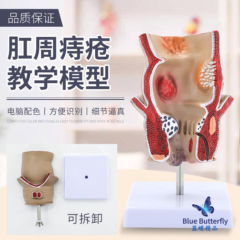 Straight Intestines Hemorrhoids Disease Turns into Model Hemorrhoids Internal and External Anatomy Anal and Intestinal Surgery Large Intestine Intestinal Pathology Model