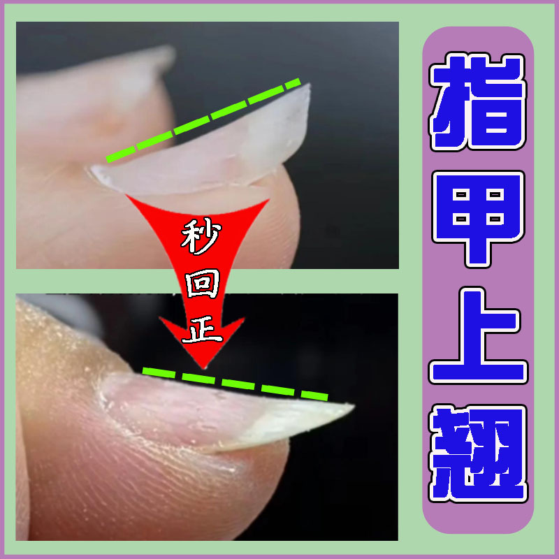 Nails Are Warped, Deformed, Damaged, Curved, Uneven, Abnormally Shaped, Spoon-Shaped, Cracked, Short, Mild Correction Herbal Solution