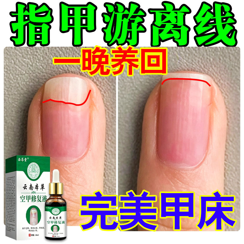 Nail Free-Edge Growth Solution for Separating Nail Beds and Correcting Uneven Nail Surfaces, Correcting Free-Edge Nails Nail Free-Edge Growth Solution for Separating Nail Beds and Correcting Uneven Nail Surfaces, Correcting Free-Edge Nails