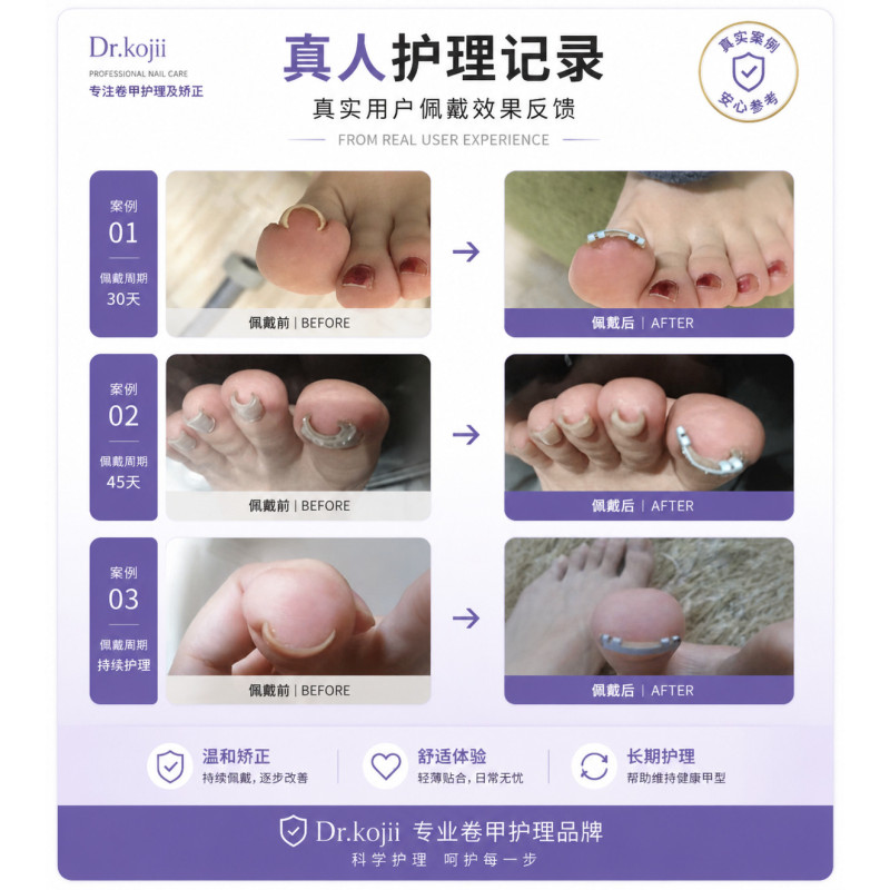 Japanese Oniwa Roll Nail Correction Device, Nail Correction Patch, Ingrown Nail Correction, Nail Groove Correction, Nail Correction for Nails Growing into the Flesh