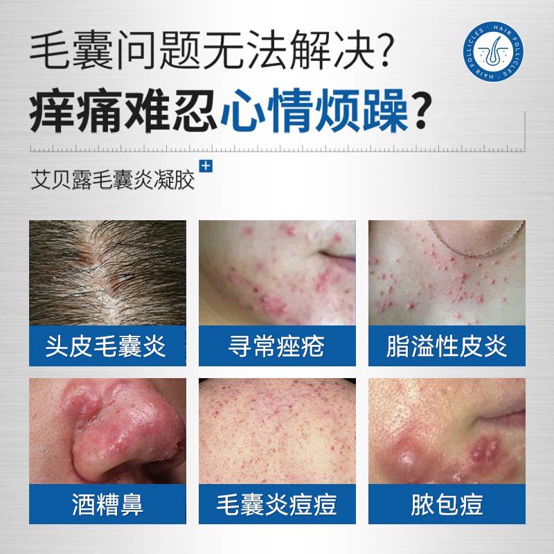 艾贝露毛囊炎凝胶:告别红肿脓痘,重塑清爽肌肤!💪-保健理疗-淘宝百科网