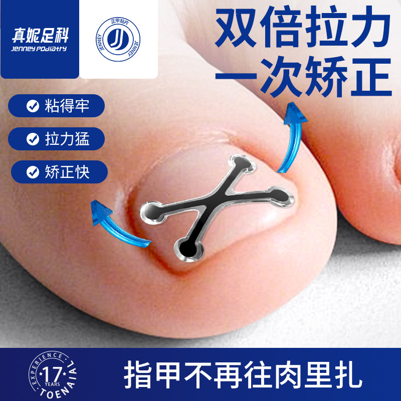 Zhen Ni Foot Care Ingrown Toenail Corrector Patch for Inflamed Ingrown Nails, Special for Toenails That Grow into the Flesh