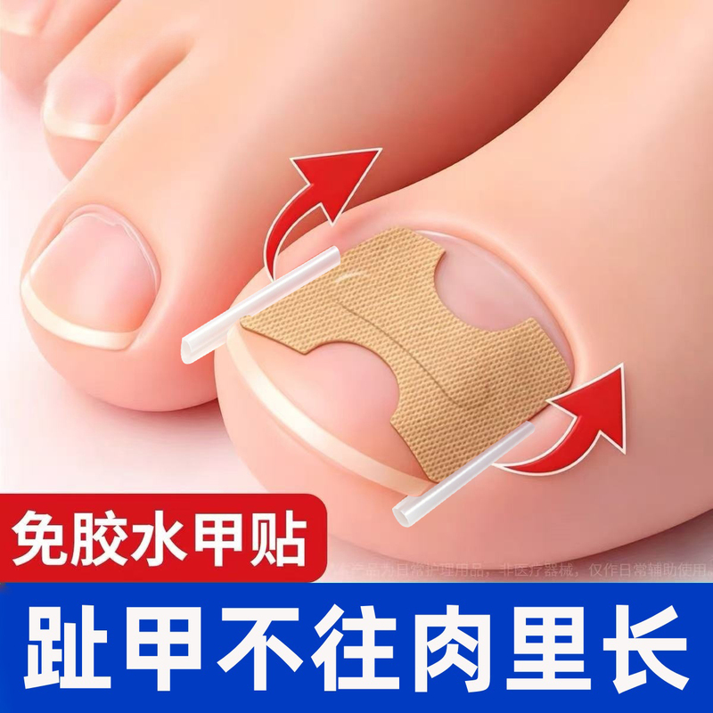 Ingrown Toenail Corrector, Special Isolation Patch for Correcting Ingrown Toenails, Correcting Toenail Inflammation, Home-Use Tool for Nail Groove Ingrown Toenail Corrector, Special Isolation Patch for Correcting Ingrown Toenails, Correcting Toenail Inflammation, Home-Use Tool for Nail Groove