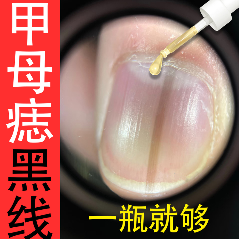 Nail Care Solution for Lightening Black Lines and Vertical Black Lines on Fingernails and Toenails