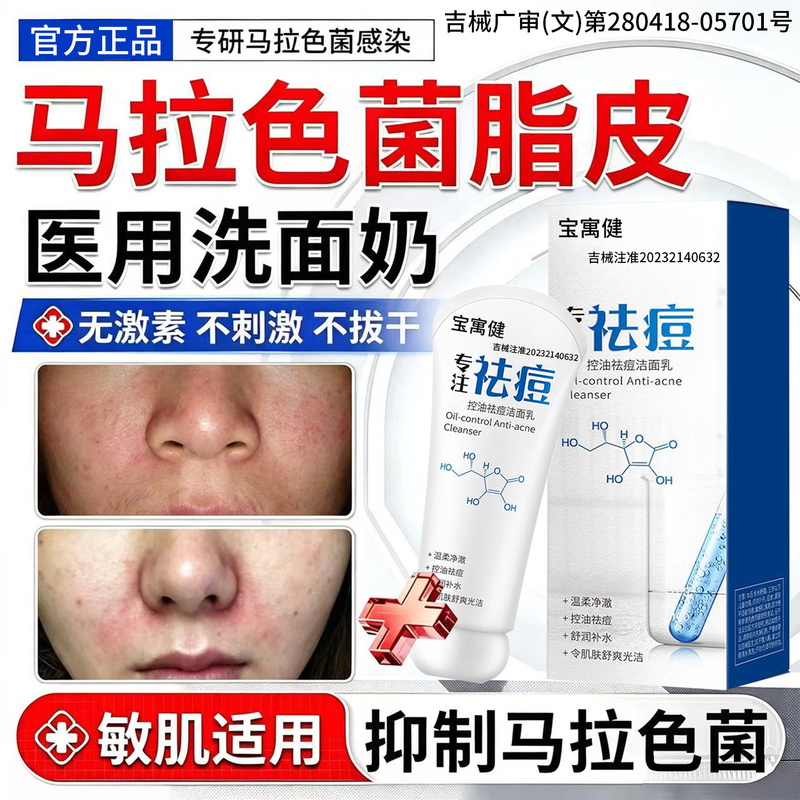 Malassezia Seborrheic Dermatitis Facial Cleanser, Facial Repair Skin Care Products, Medical Cleansing, Antibacterial, Oil Control, Acne Removal Lotion Malassezia Seborrheic Dermatitis Facial Cleanser, Facial Repair Skin Care Products, Medical Cleansing, Antibacterial, Oil Control, Acne Removal Lotion