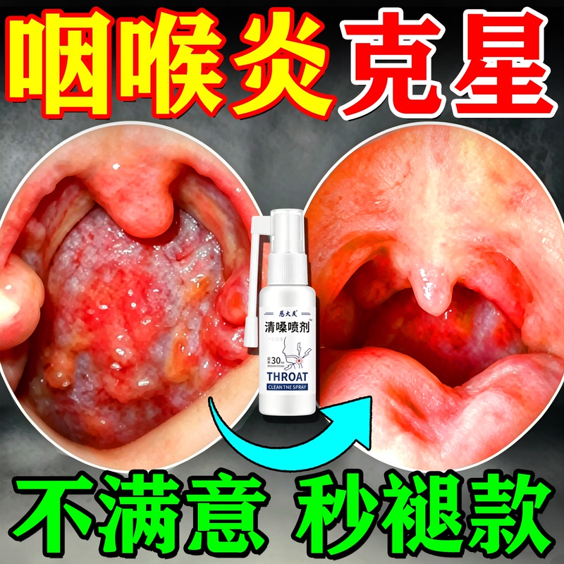 Throat Inflammation, Chronic Pharyngitis, Foreign Body Sensation, Cough, Phlegm in the Throat, Specialized Spray for Follicular Hyperplasia of the Throat Throat Inflammation, Chronic Pharyngitis, Foreign Body Sensation, Cough, Phlegm in the Throat, Specialized Spray for Follicular Hyperplasia of the Throat
