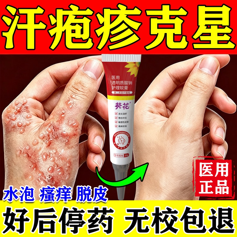 Anti-Itching Ointment for Sweat Blisters, Small Blisters on Hands, Peeling Skin, Fungal Infection, Antibacterial Ointment Anti-Itching Ointment for Sweat Blisters, Small Blisters on Hands, Peeling Skin, Fungal Infection, Antibacterial Ointment