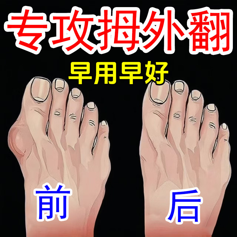 拇外翻膏贴大脚骨关节变形防磨神器，告别拇囊炎，轻松矫正大脚骨！-身体护理套装-淘宝好物网