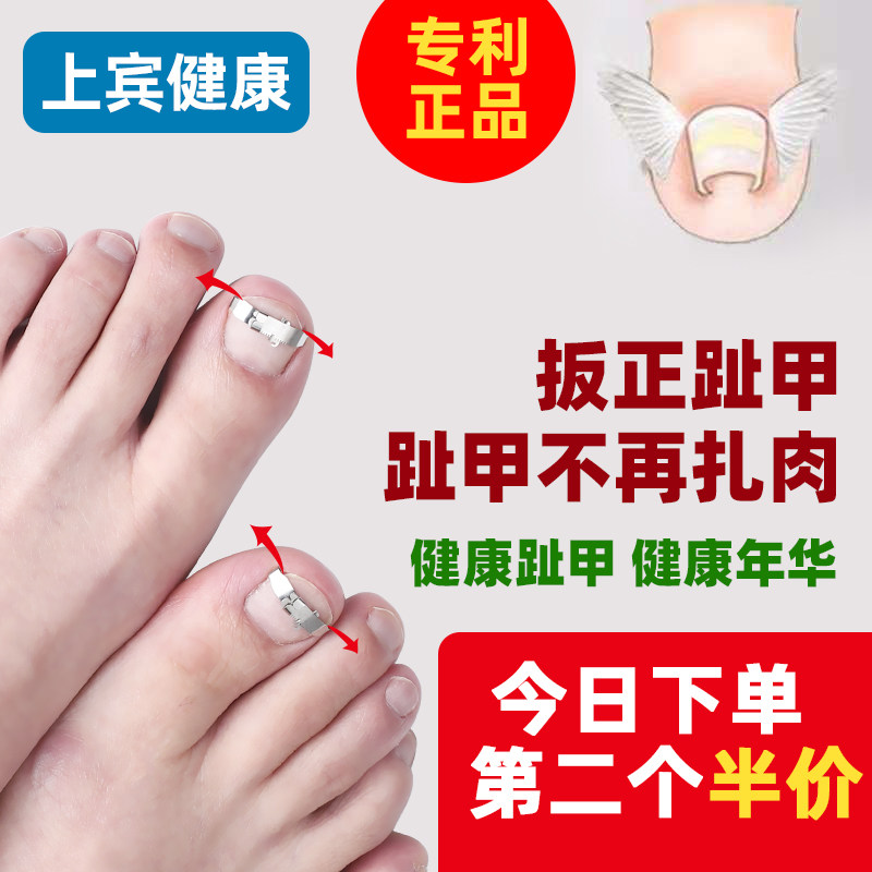 正甲扣甲溝嵌甲矯正器腳指趾甲長肉裏矯正貼片神器專用修正拉拉炎