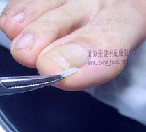 Tablet inflammation long meat regular nail nail nail groove tool nail groove filling cushion orthosis