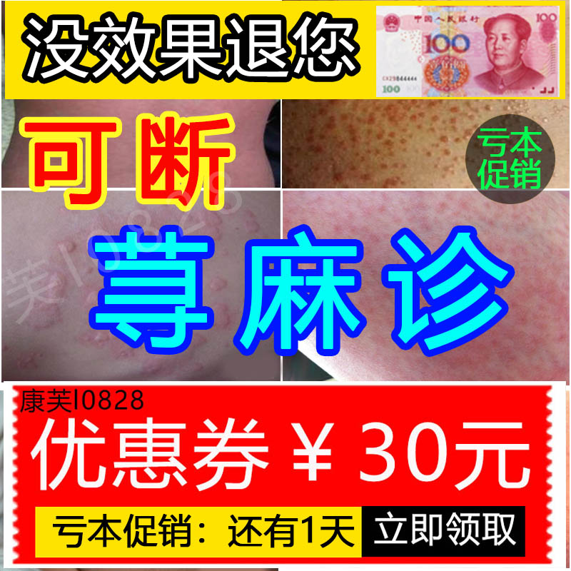 Treatment for acute and chronic urticaria Measles Cream Traditional Chinese Medicine Allergy Skin Itching Wind Group Disease Japan Anti-Itch Cream Pill